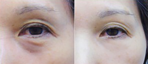 Platelet Rich Plasma